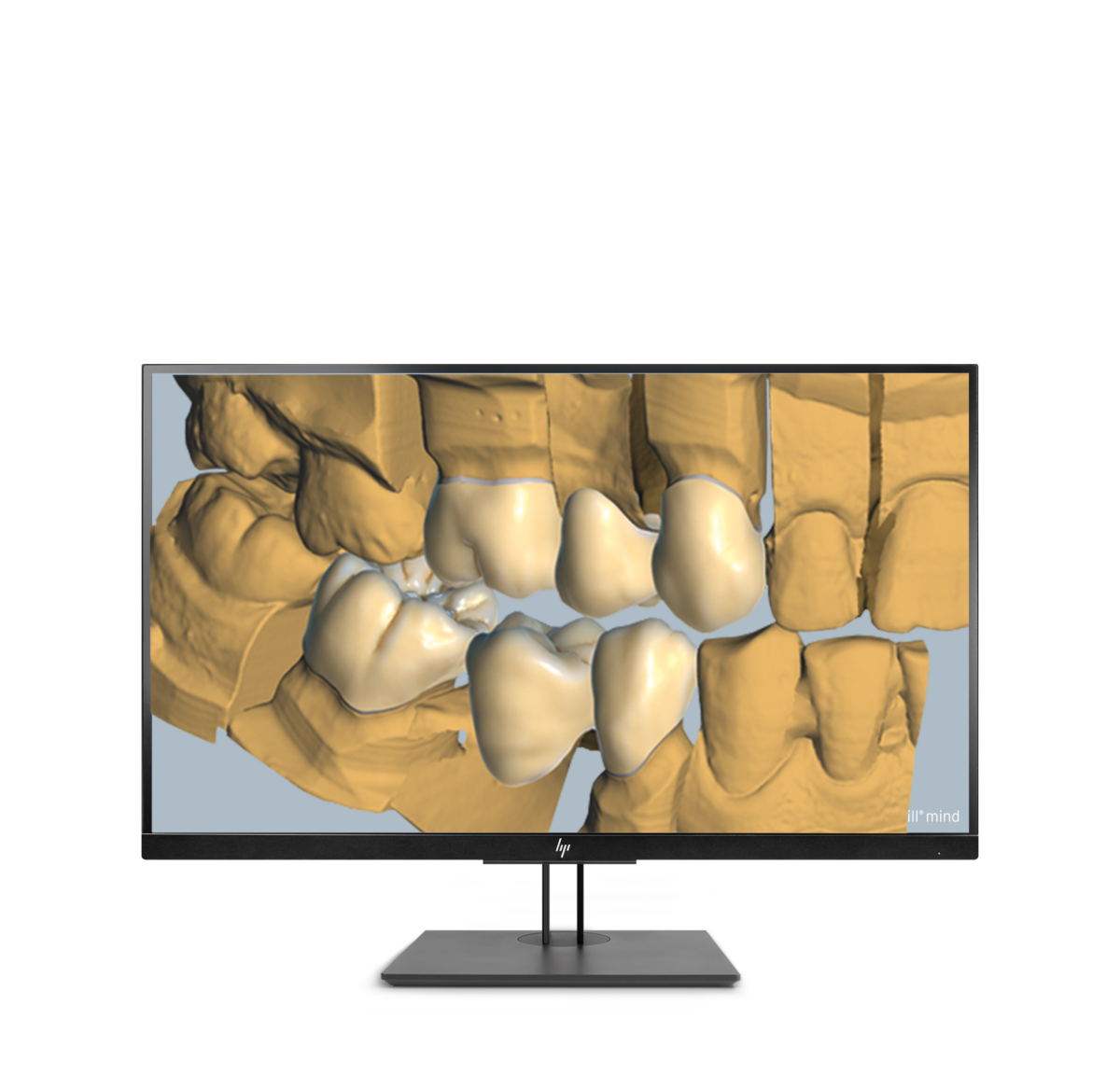 Ceramill Trusmile