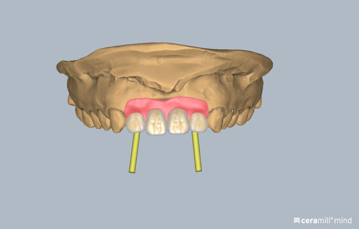 Ceramill M-Gin