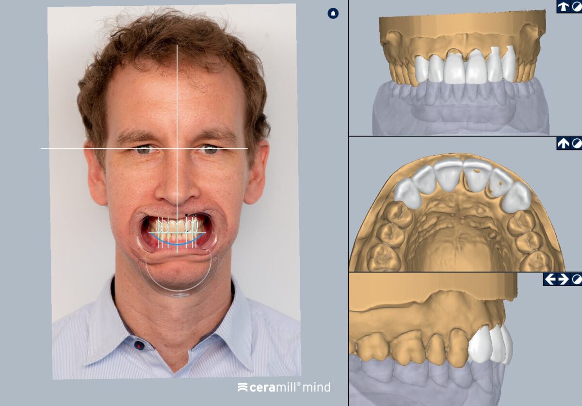 Ceramill M-Smile