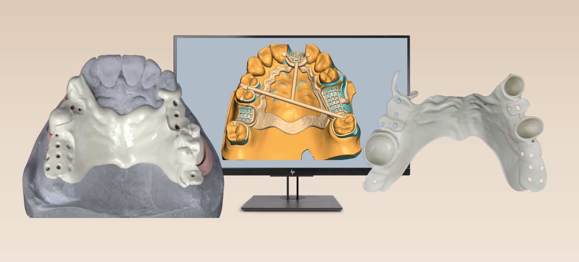 Framework Management: CAD-CAM Advanced – Teleskoptechnik mit Ceramill M-Part & UltaireTM AKP