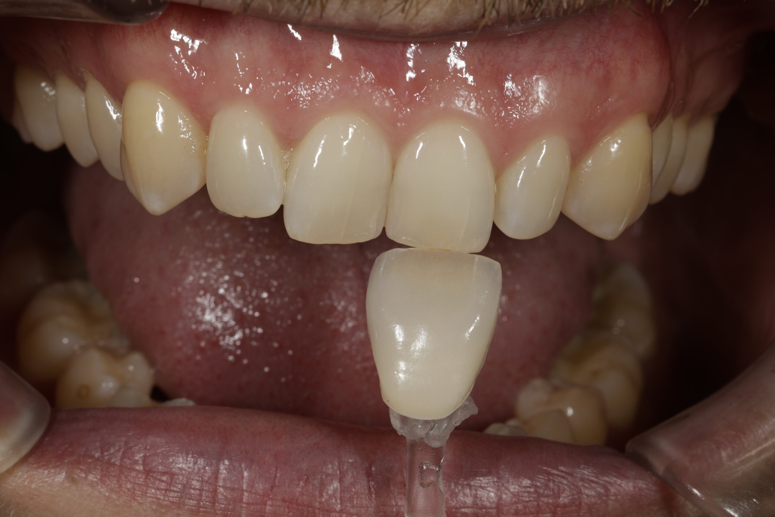 Esthetic Management &#8211; Werde ein Keramikgenie mit Optishade und Matisse