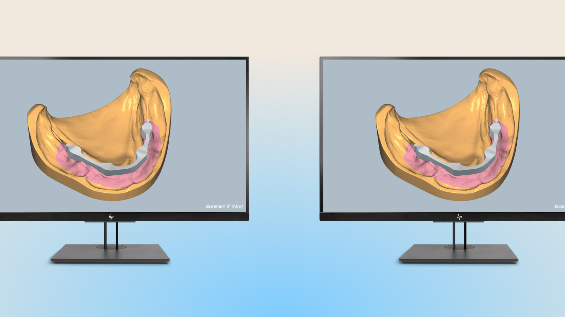 Ceramill M-Bars