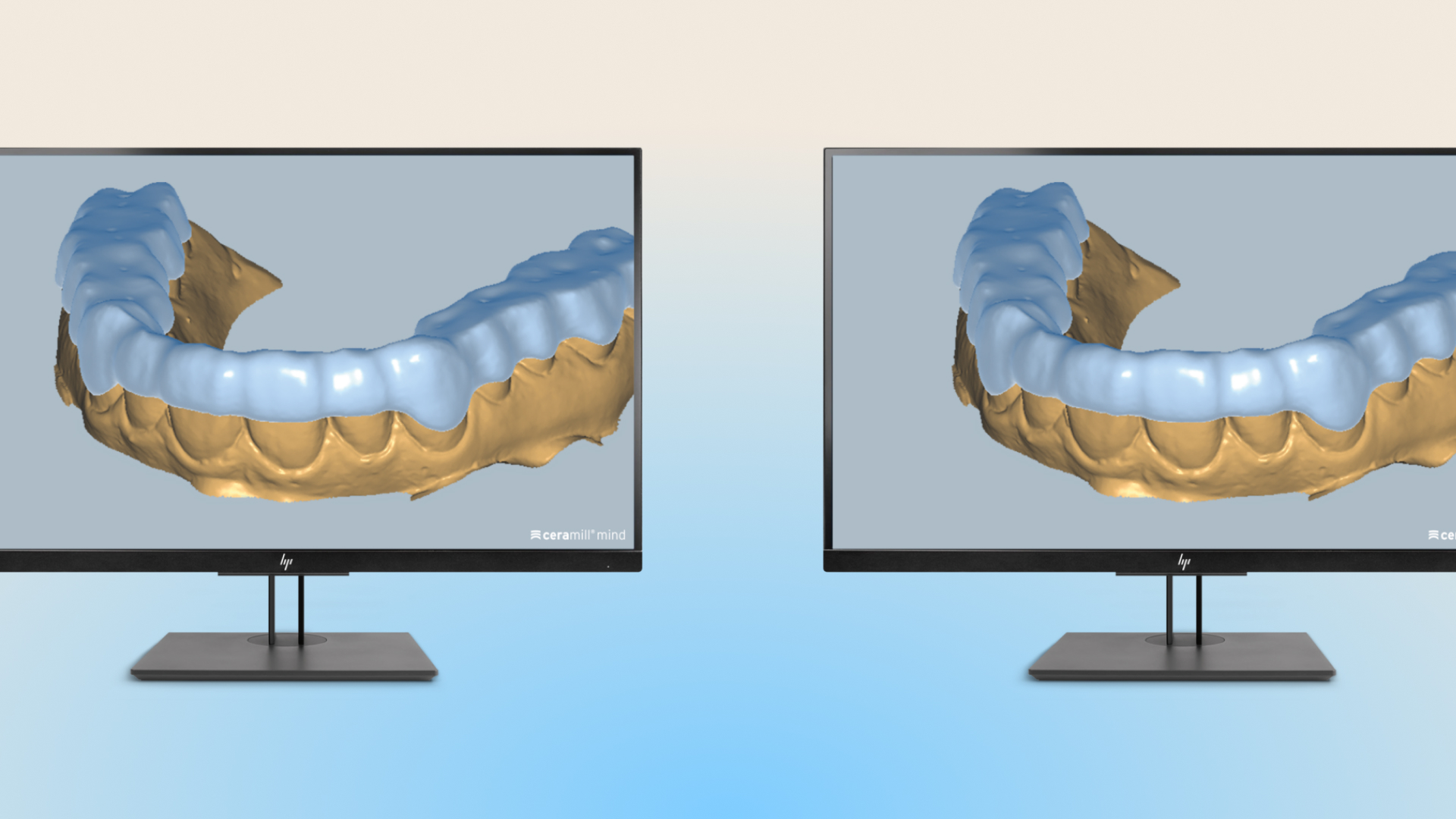 Ceramill M-Splint