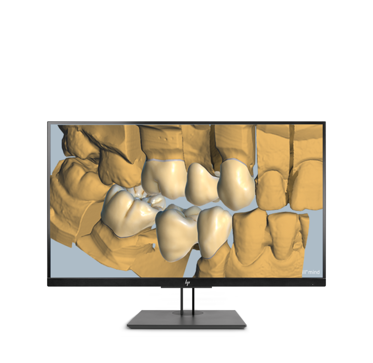 Ceramill Trusmile